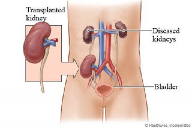 KIDNEY TRANSPLANT PROCEEDURE