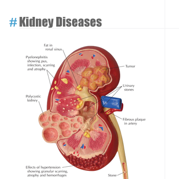 Kidney Diseases Kidney Diseases