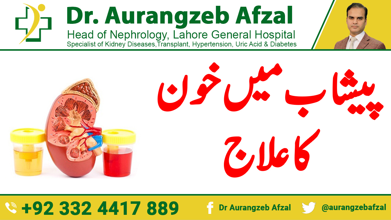 Blood in Urine (Hematuria) Causes, Symptoms and Treatments in Urdu/Hindi